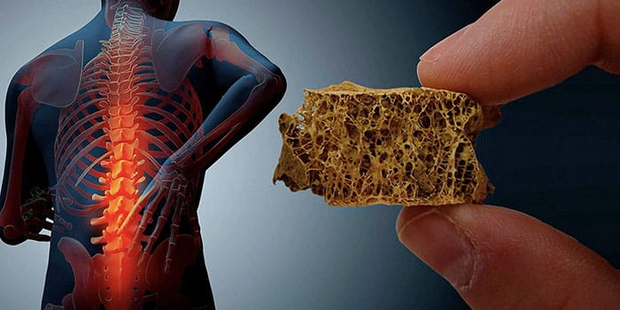 پوکی استخوان