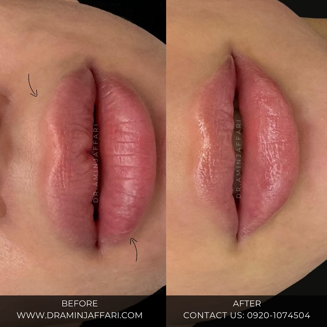 تخلیه ژل لب دکتر امین جعفری