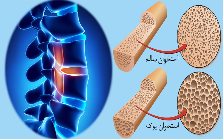 سنجش تراکم استخوان