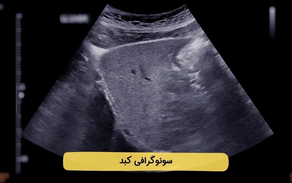 تفسیر جواب سونوگرافی کبد