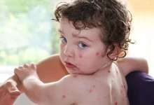 آیا آبله مرغان در دوران کودکی زمینه ساز زوال عقل در بزرگسالی می شود؟