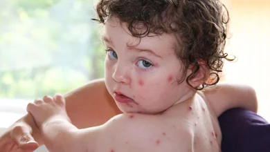 آیا آبله مرغان در دوران کودکی زمینه ساز زوال عقل در بزرگسالی می شود؟