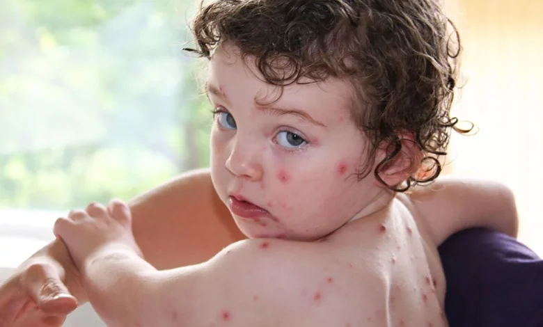آیا آبله مرغان در دوران کودکی زمینه ساز زوال عقل در بزرگسالی می شود؟