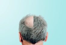 امید تازه به درمان طاسی مو