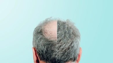 امید تازه به درمان طاسی مو