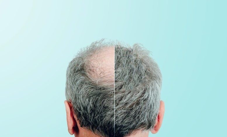 امید تازه به درمان طاسی مو