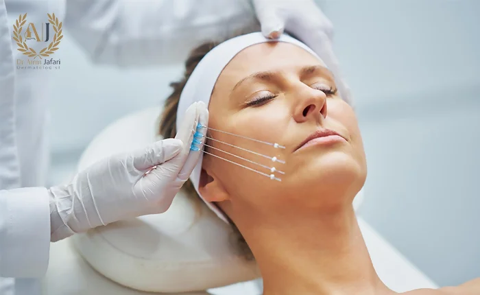 عفونت بعد از لیفت نخ