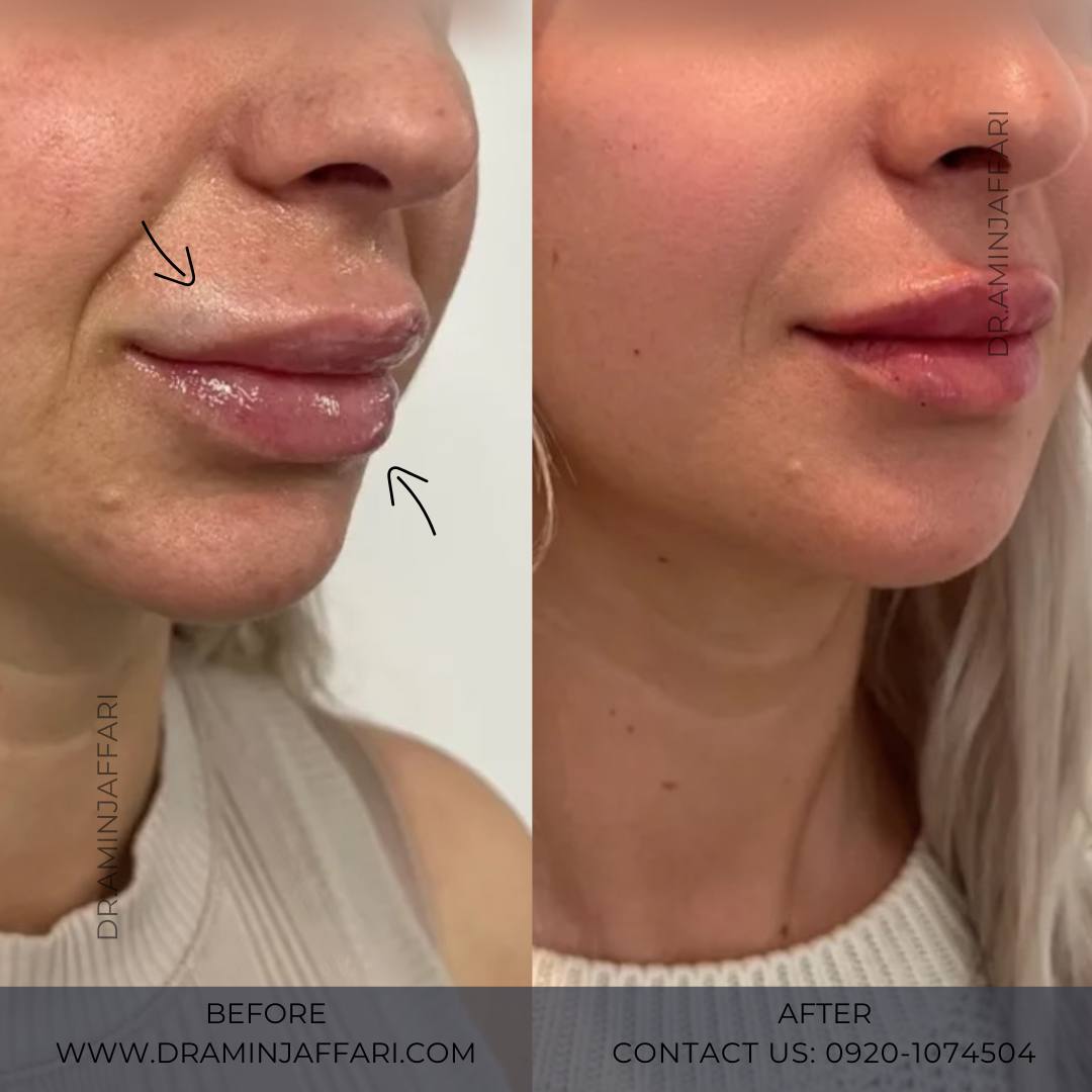 تخلیه ژل از اجزای صورت