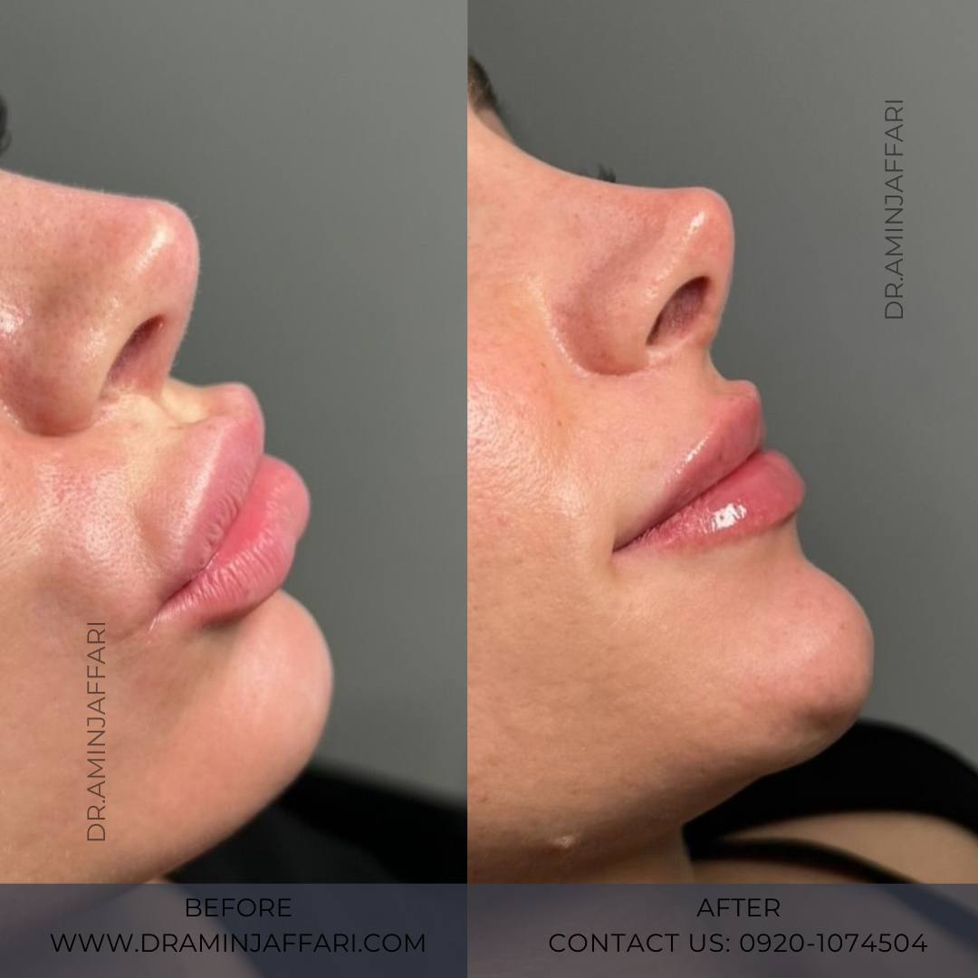 کبودی بعد از تزریق فیلر لب