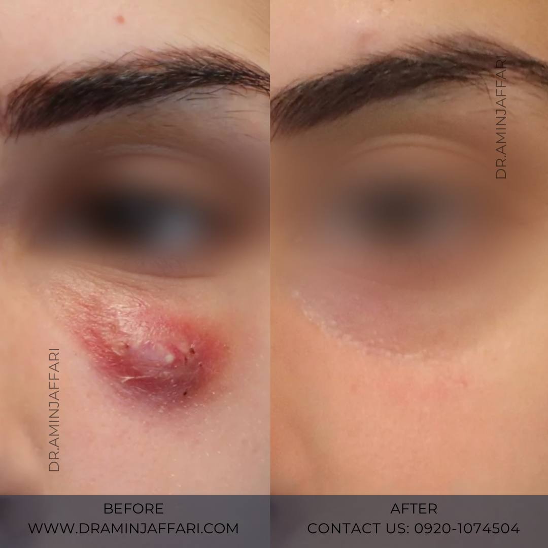 تخلیه ژل در نواحی حساس (زیر چشم، بینی و شقیقه)