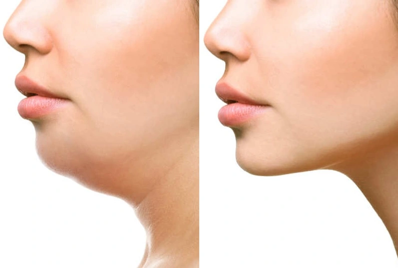 لیپوفیس جراحی 