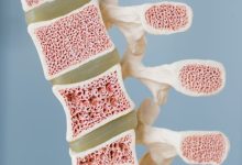 تغییرات خاموش در مغز استخوان می تواند علائم اولیه سرطان خون باشد