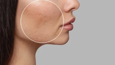 بهترین روشهای درمان منافذ باز پوست