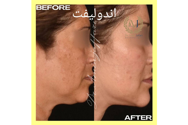 زاویهسازی و لیفت صورت با اندولیفت ایتالیایی