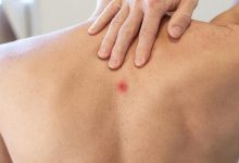 چرا روی بازو و کمر جوش میزنه؟