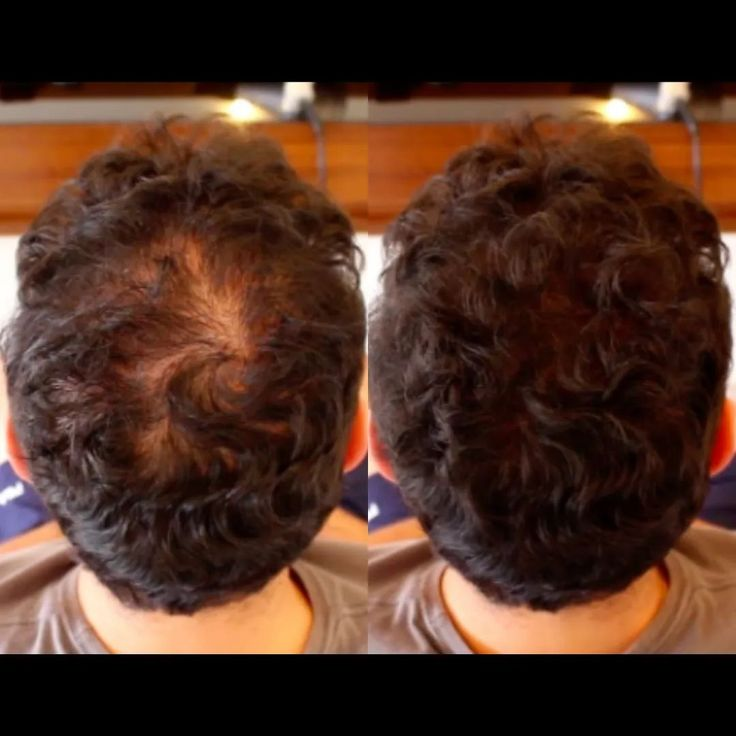 عکس قبل و بعد رویش مو