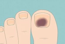 دلایل شایع تیرگی ناخن های پا