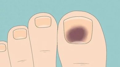 دلایل شایع تیرگی ناخن های پا