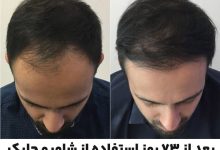 با این شامپوها کچل می‌شوید!