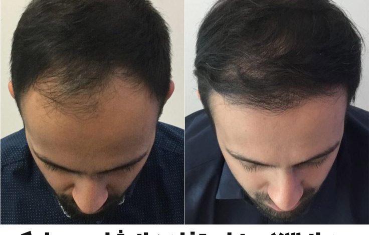 با این شامپوها کچل میشوید!